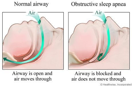 apnea diagram